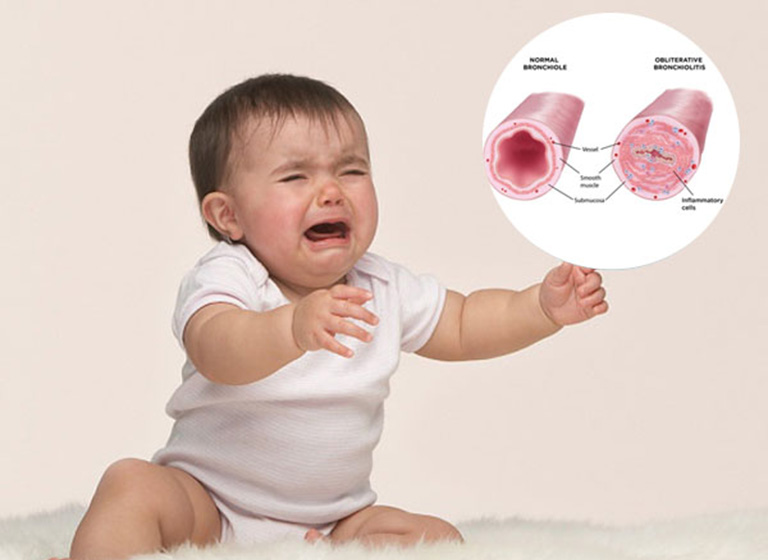 Viêm tiểu phế quản là bệnh thường xảy ra với trẻ nhỏ từ 6 tháng đến 3 tuổi