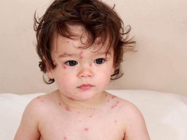 Thủy đậu bệnh truyền nhiễm gây nhiều biến chứng nguy hiểm ở trẻ nhỏ